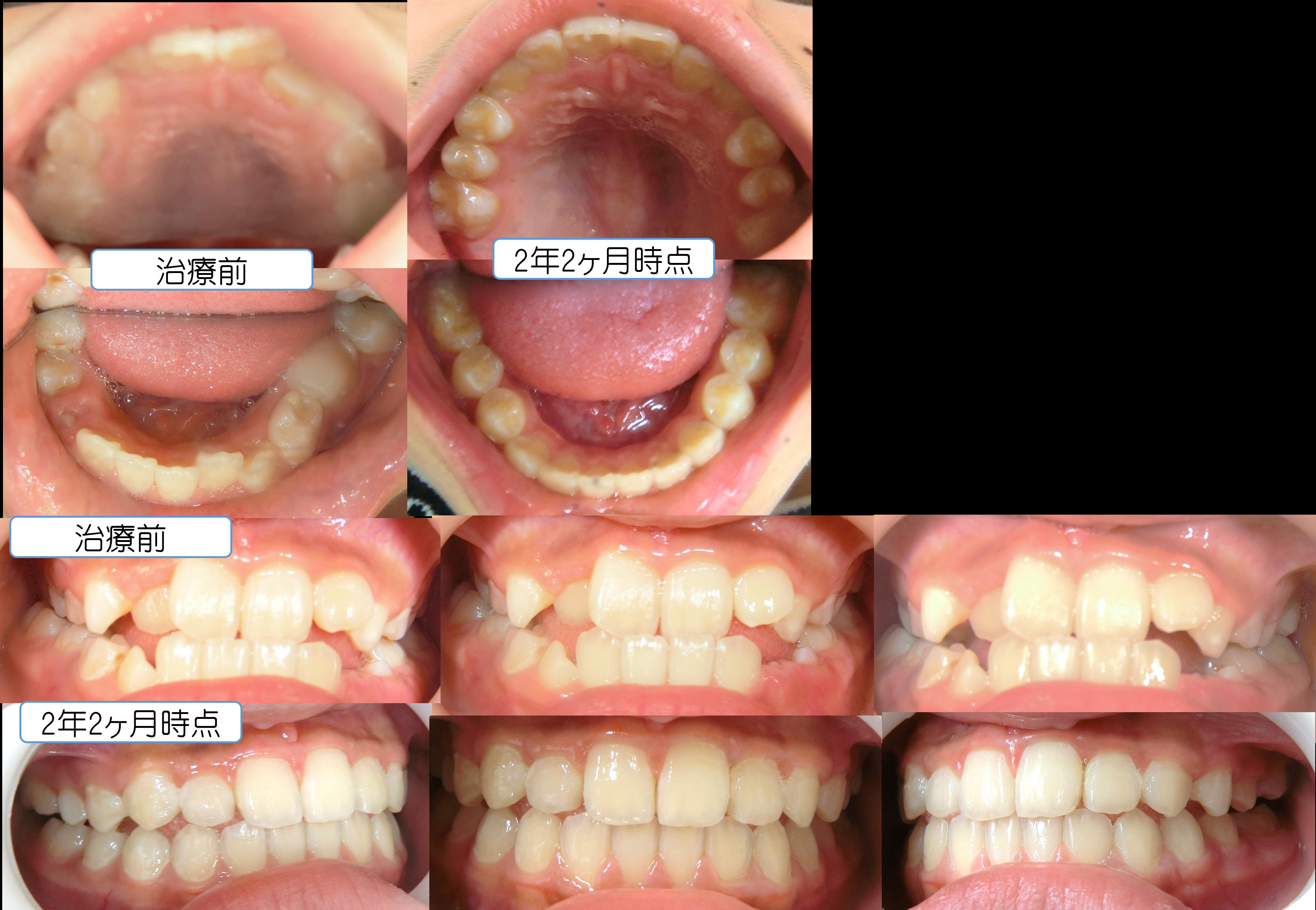 インビザライン矯正˚✧₊症例写真のご紹介です！