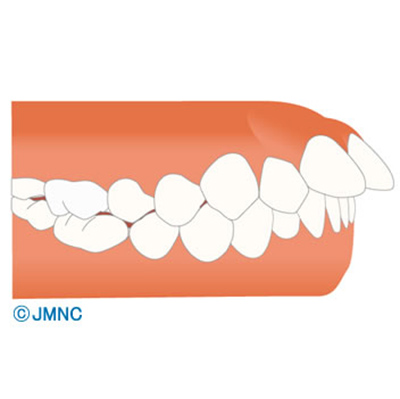 上顎前突（出っ歯）不正咬合