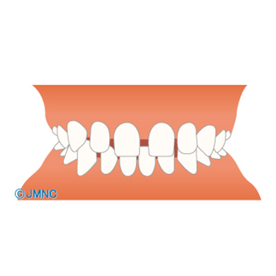 空隙歯列（すきっ歯）不正咬合